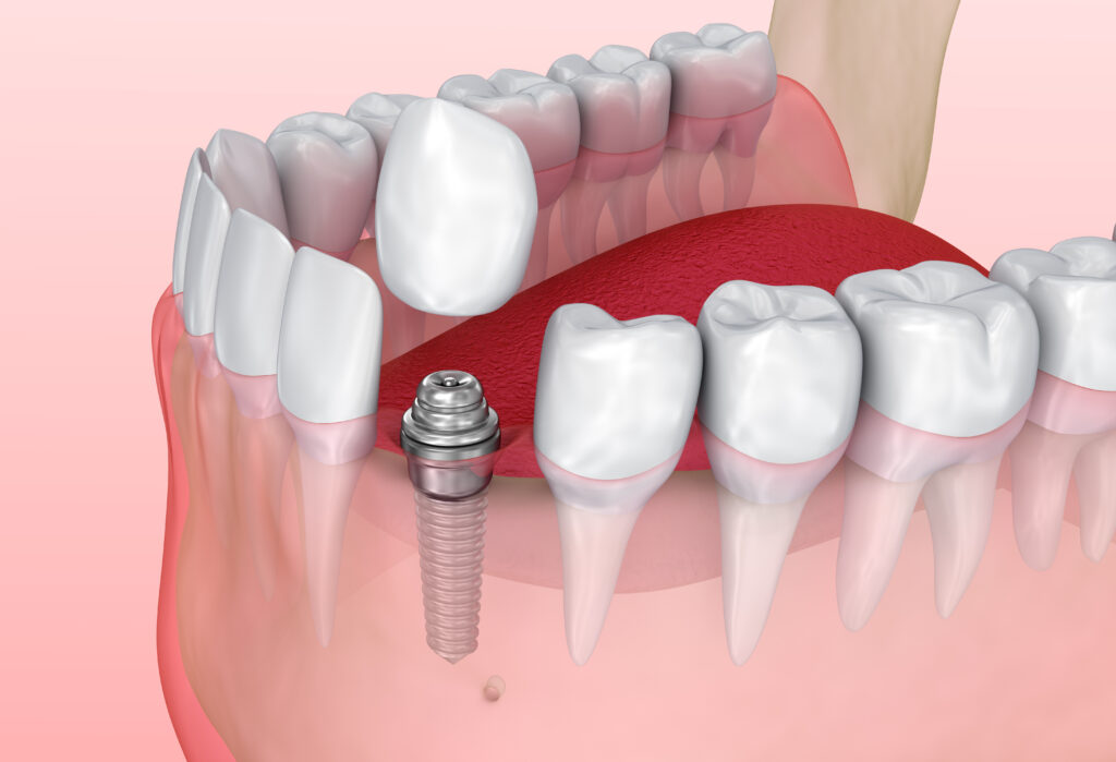 Tooth implant installation process, Medically accurate 3D illustration
