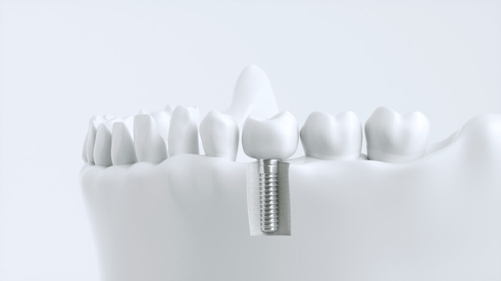 Zahnimplantat mit Knochenstruktur